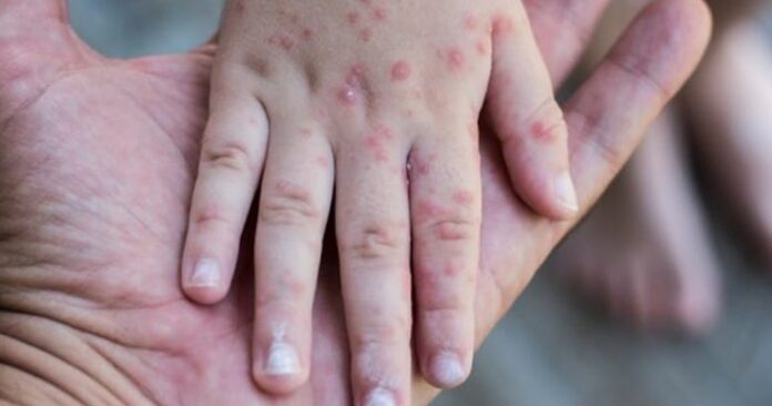 Aktivitas Luar Tetap Aman, Ini Tips Hindari Penularan Campak