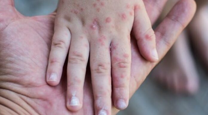 Aktivitas Luar Tetap Aman, Ini Tips Hindari Penularan Campak Aktivitas Luar Tetap Aman, Ini Tips Hindari Penularan Campak