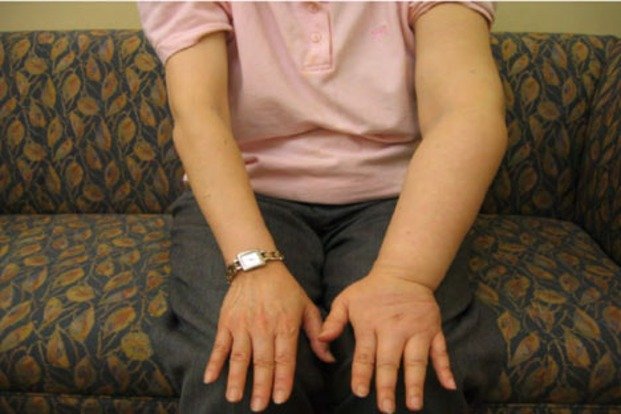 Kenali Limfedema, Pembengkakan yang Bisa Muncul Setelah Pengobatan Kanker Kenali Limfedema, Pembengkakan yang Bisa Muncul Setelah Pengobatan Kanker